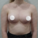 Galaflex Mesh - Internal Bra for Breast Augmentation