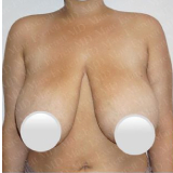 Internal Bra with a breast reduction?