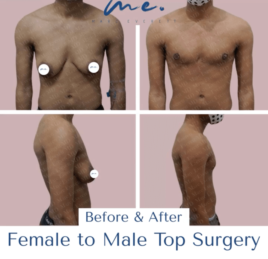 Non-binary Top Surgery Techniques