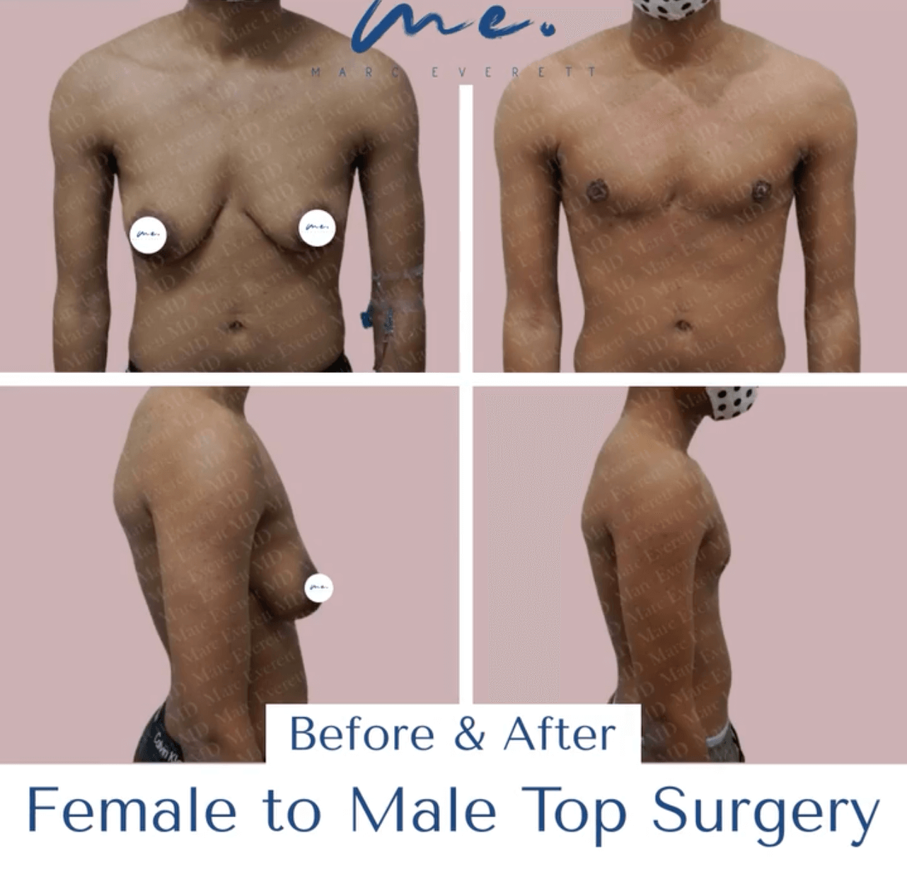 double mastectomy scars ftm