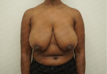 Plastic Surgeon Reacts to INCREDIBLE Breast Reduction! 
