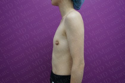 Breast Augmentation Before & After Patient #2481
