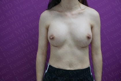 Breast Augmentation Before & After Patient #2481