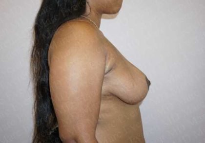 Breast Lift Before & After Patient #1126