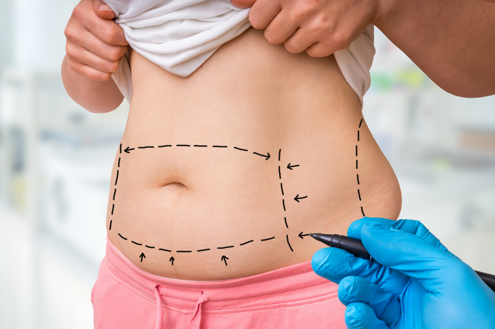 Liposuction or Tummy Tuck: Which One Is Right for You?