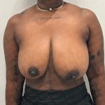 Breast Reduction Before & After Patient #3380