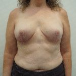 Breast Reduction Before & After Patient #3382