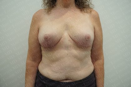 Breast Reduction Before & After Patient #3382