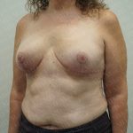 Breast Reduction Before & After Patient #3382