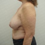 Breast Reduction Before & After Patient #3382