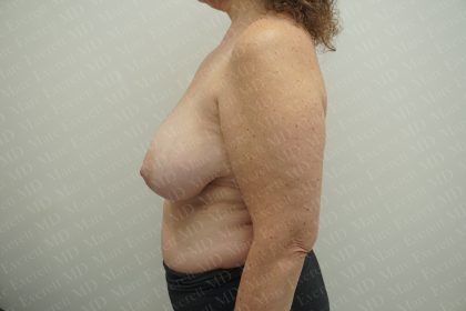 Breast Reduction Before & After Patient #3382