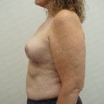 Breast Reduction Before & After Patient #3382