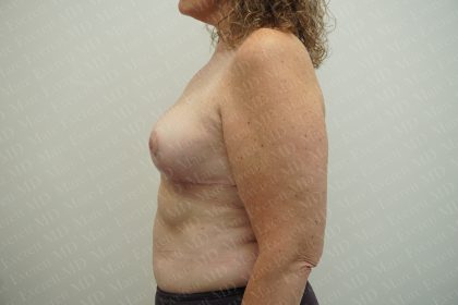 Breast Reduction Before & After Patient #3382