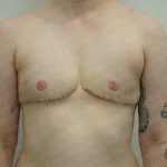 Chest Masculinization Surgery Before & After Patient #3384