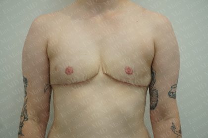 Chest Masculinization Surgery Before & After Patient #3384