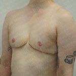 Chest Masculinization Surgery Before & After Patient #3384